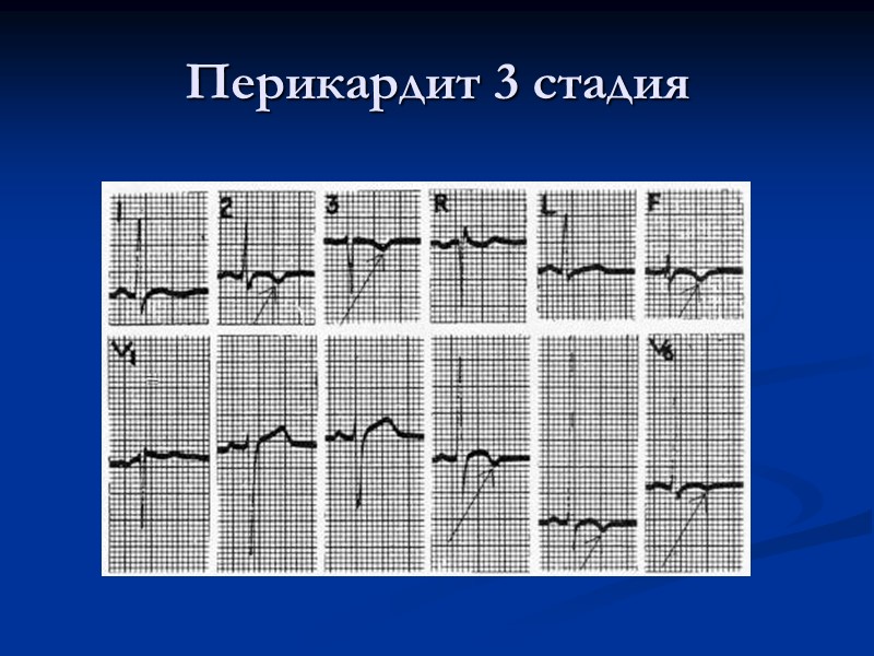 Перикардит 3 стадия